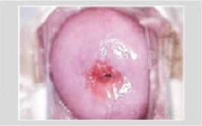 Hình ảnh bệnh viêm lộ tuyến cổ tử cung độ 1