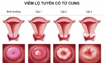 viem-lo-tuyen-co-tu-cung-co-may-cap-do