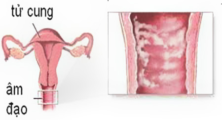 Cách vệ sinh vùng kín khi bị viêm âm đạo